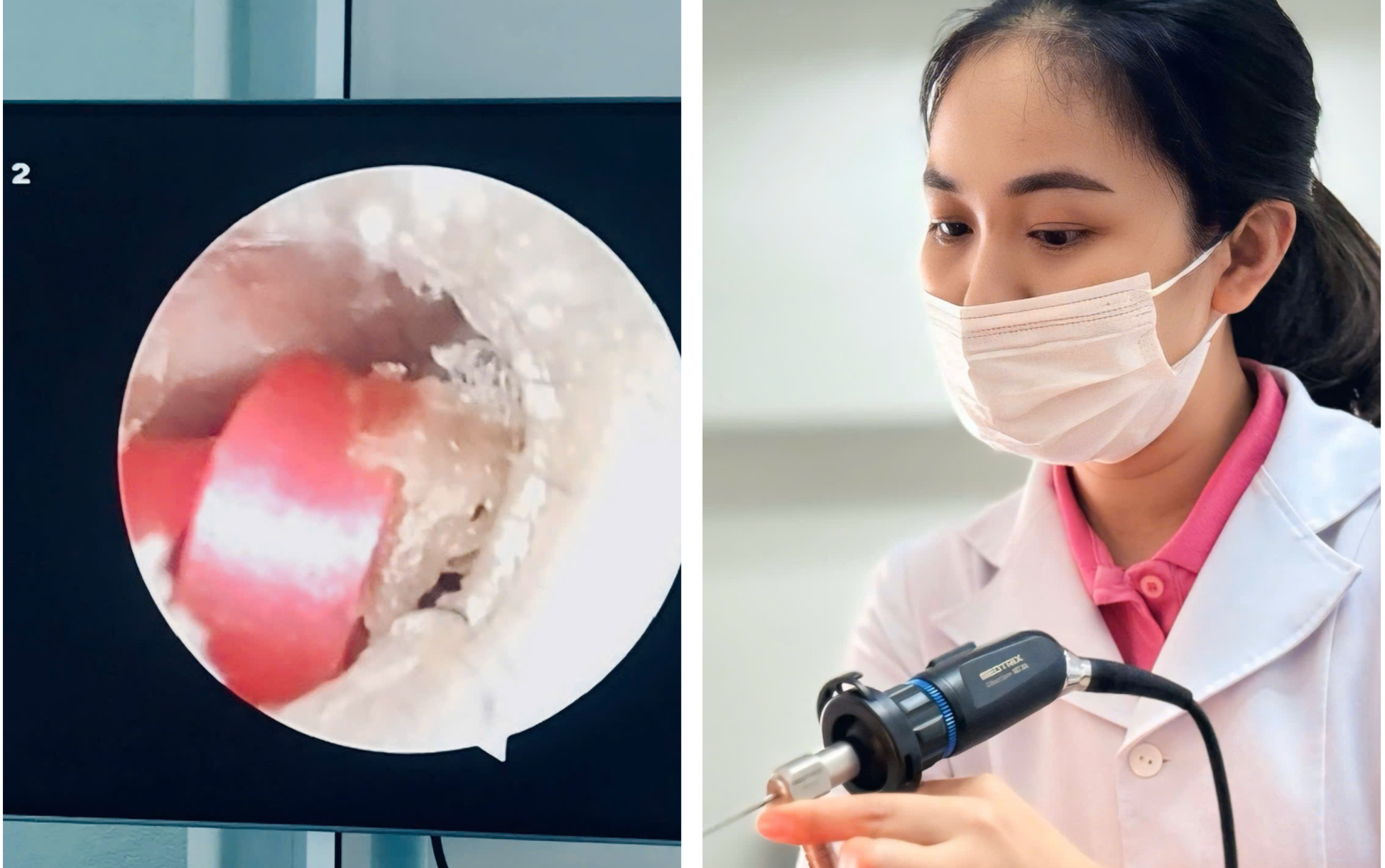B&eacute; g&aacute;i su&yacute;t thủng m&agrave;ng nhĩ v&igrave; dị vật l&agrave; sợi d&acirc;y buộc t&oacute;c- Ảnh 1.