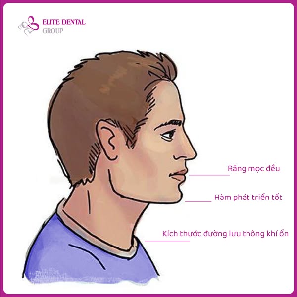Trẻ thở bằng miệng khi ngủ? Đừng bỏ qua dấu hiệu khiến xương h&agrave;m ph&aacute;t triển lệch lạc- Ảnh 1.