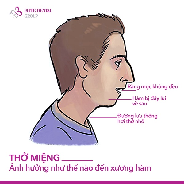 Trẻ thở bằng miệng khi ngủ? Đừng bỏ qua dấu hiệu khiến xương h&agrave;m ph&aacute;t triển lệch lạc- Ảnh 2.
