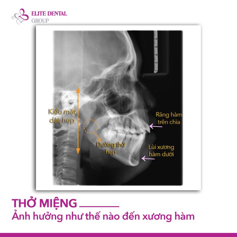 Trẻ thở bằng miệng khi ngủ? Đừng bỏ qua dấu hiệu khiến xương h&agrave;m ph&aacute;t triển lệch lạc- Ảnh 4.