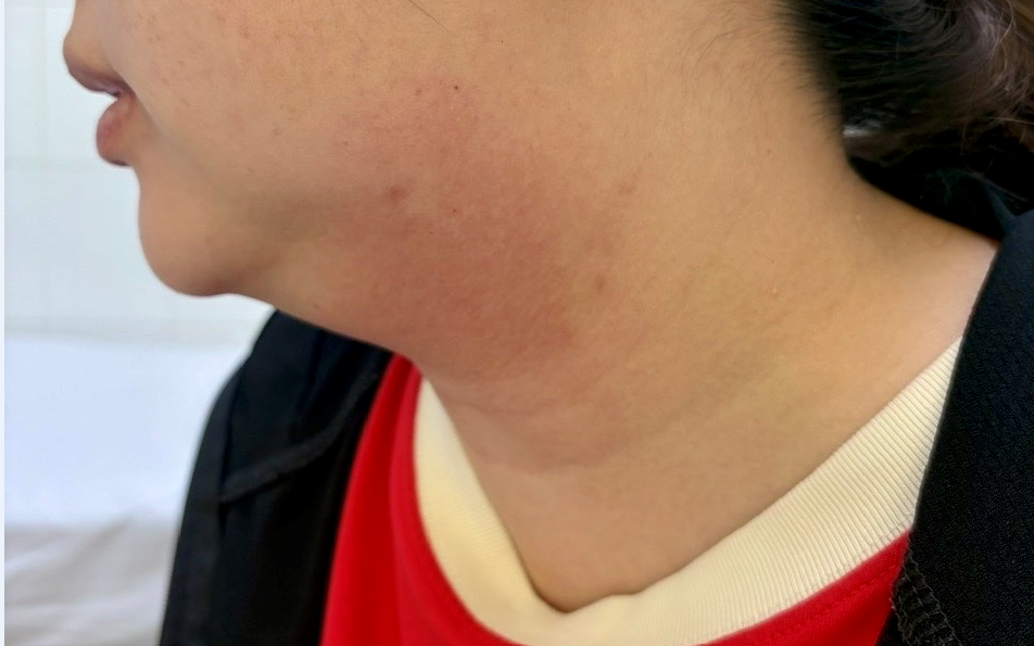 Người phụ nữ 33 tuổi ở miền Tây suýt trả giá đắt vì muốn tan mỡ 