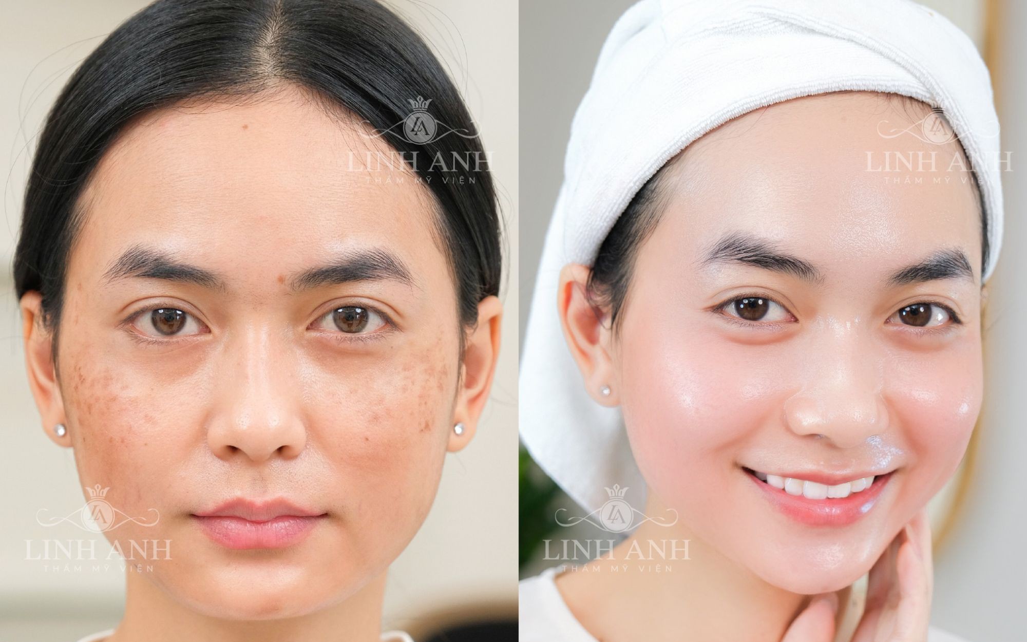 Chọn chuẩn, an tâm trẻ hóa da tại Thẩm mỹ viện Linh Anh