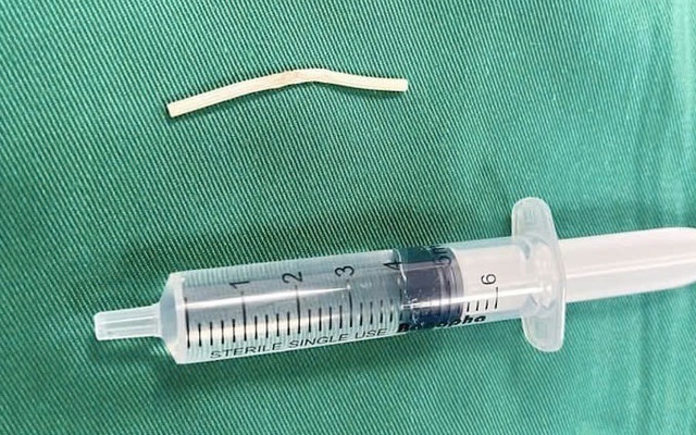 Que tránh thai “đi lạc” suốt 4 tháng trong bắp tay