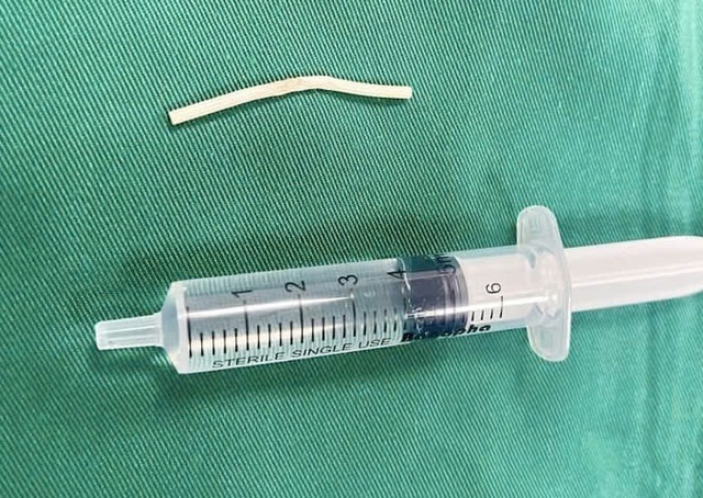 Que tránh thai “đi lạc” suốt 4 tháng trong bắp tay- Ảnh 1.