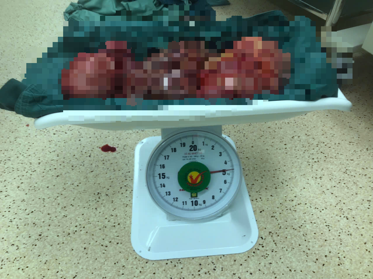 Bệnh viện Vũng Tàu tách khối u nặng 5 kg khỏi bụng người phụ nữ 56 tuổi- Ảnh 1.