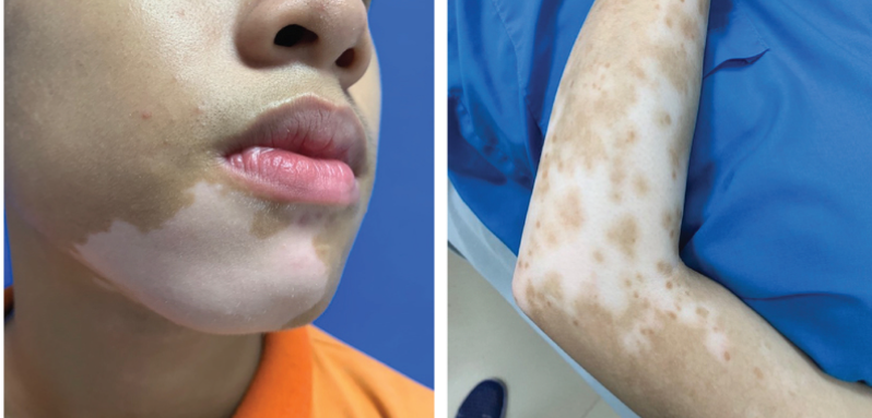 Người mắc bệnh mất sắc tố da được khám miễn phí- Ảnh 1.