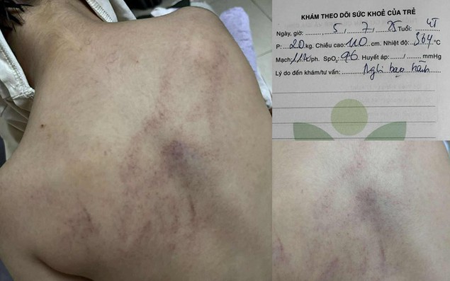 Vụ trẻ nghi bị cô giáo bạo hành: Cơ quan chức năng lên tiếng