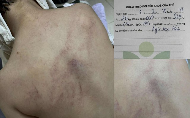 Vụ trẻ nghi bị cô giáo bạo hành: Cơ quan chức năng lên tiếng- Ảnh 1.