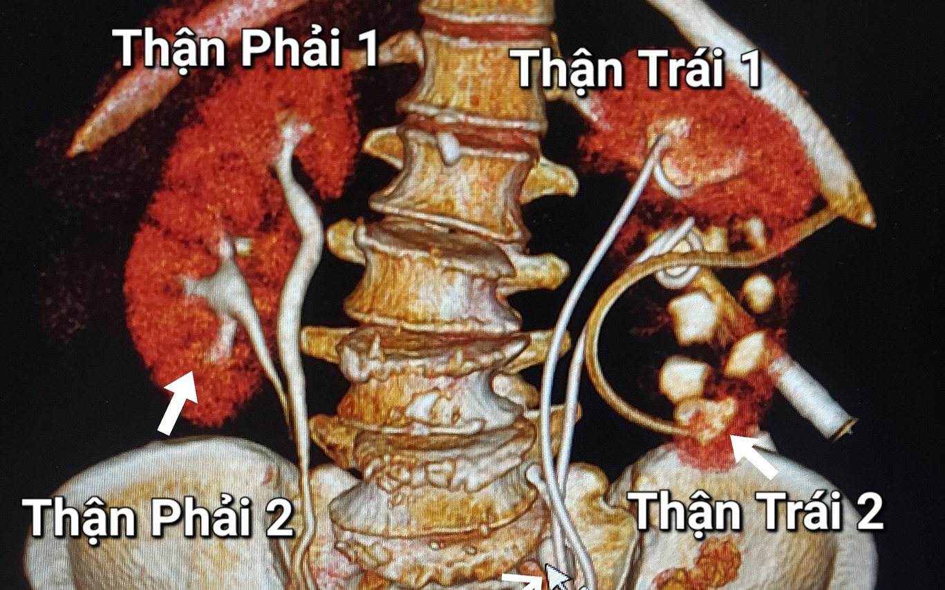 Người phụ nữ được phát hiện có 4 quả thận khi khám đau lưng