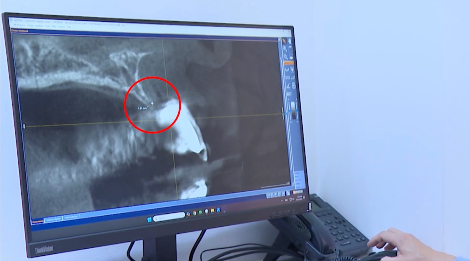 Cấy gh&eacute;p Implant th&agrave;nh c&ocirc;ng v&agrave; vai tr&ograve; kh&ocirc;ng thể thiếu của gh&eacute;p xương- Ảnh 2.