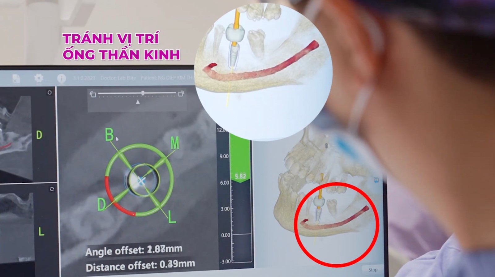Cấy gh&eacute;p Implant th&agrave;nh c&ocirc;ng v&agrave; vai tr&ograve; kh&ocirc;ng thể thiếu của gh&eacute;p xương- Ảnh 3.