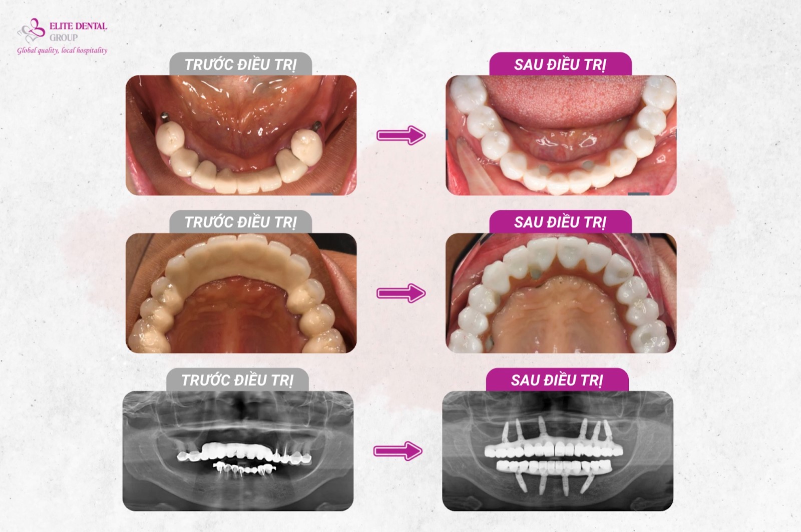 Cấy gh&eacute;p Implant th&agrave;nh c&ocirc;ng v&agrave; vai tr&ograve; kh&ocirc;ng thể thiếu của gh&eacute;p xương- Ảnh 4.