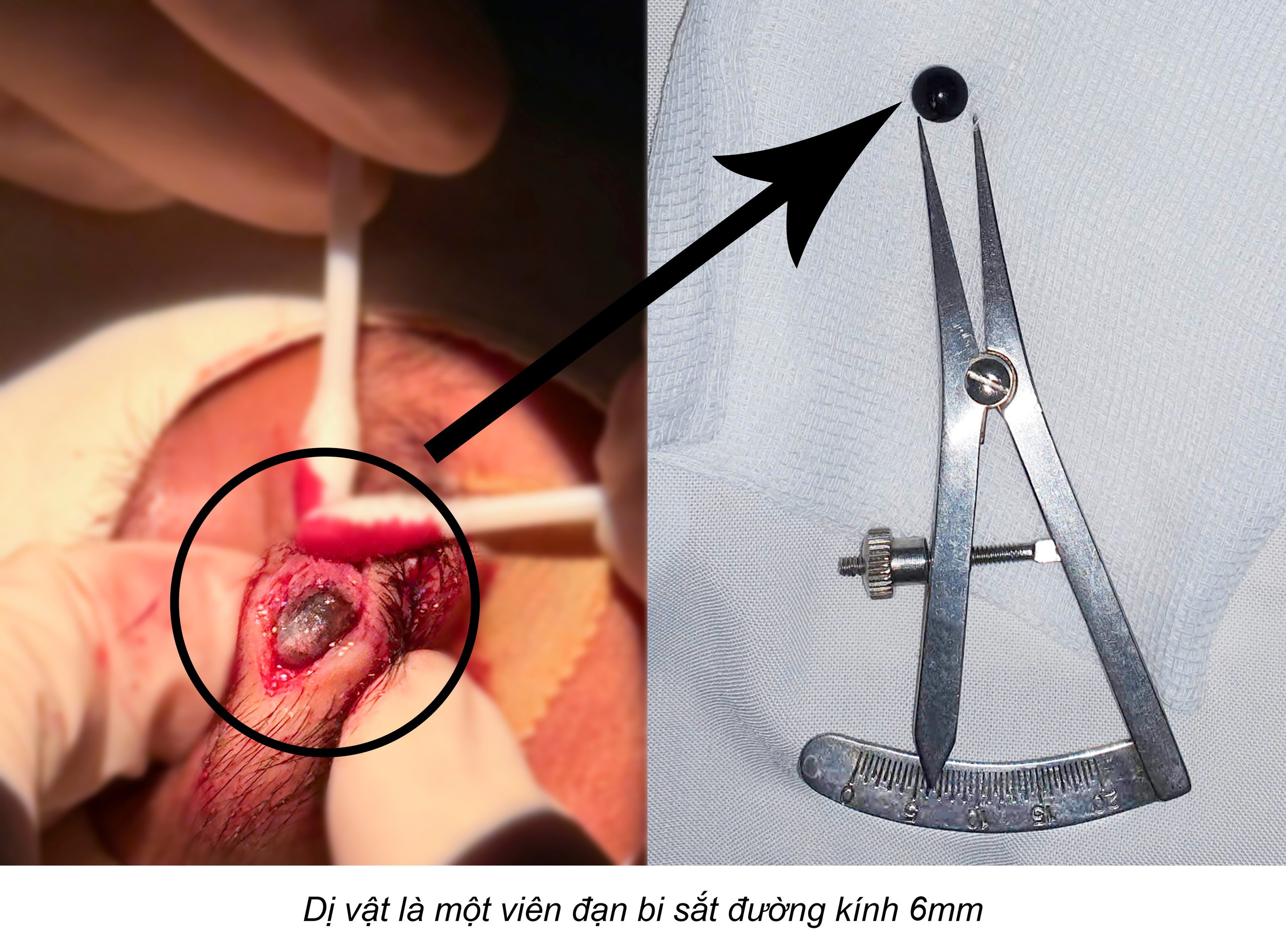 Vi&ecirc;n bi sắt 6 mm nằm trong m&iacute; mắt nam sinh 15 tuổi suốt nhiều ng&agrave;y- Ảnh 1.