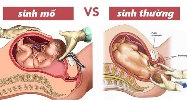 Mất con vì chọn ngày giờ sinh mổ - Ảnh 2.