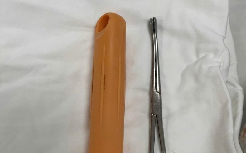 Cán cây lau nhà lọt sâu trong trực tràng nam thanh niên 23 tuổi