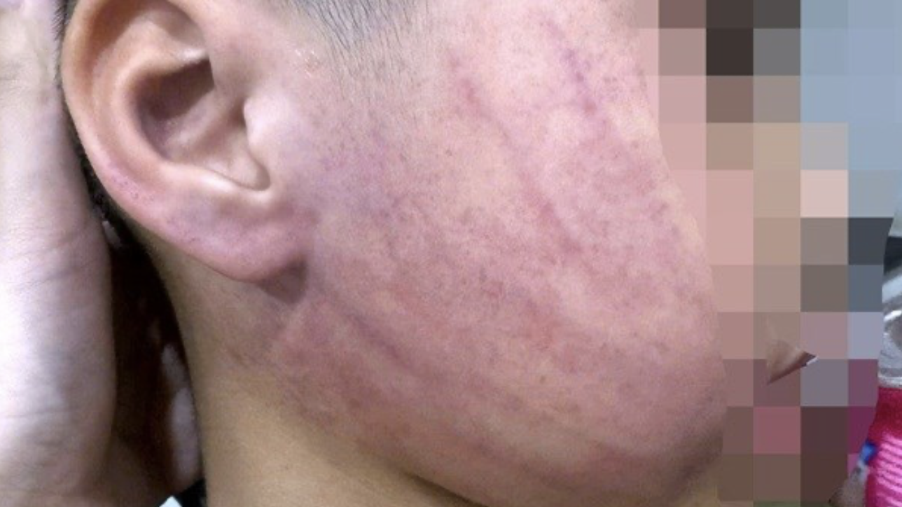 Điều tra vụ b&eacute; 4 tuổi bị gi&aacute;o vi&ecirc;n đ&aacute;nh tại trường mầm non T . Đ - Ảnh 1.