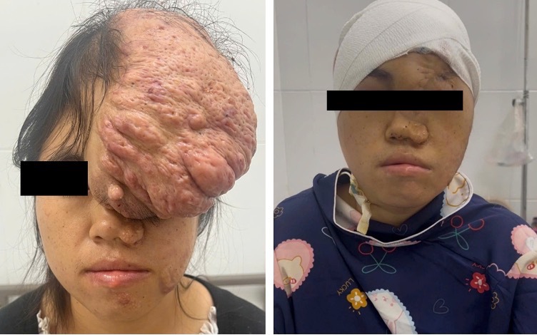 Ngỡ ngàng khuôn mặt cô gái sau 15 năm bị khối u khổng lồ đeo bám