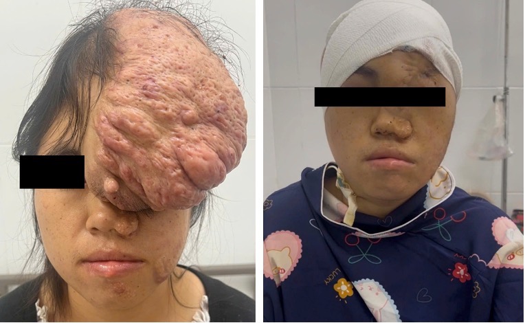 Khối u khổng lồ tr&ecirc;n mặt khiến c&ocirc; g&aacute;i sống ẩn m&igrave;nh 15 năm - Ảnh 1.