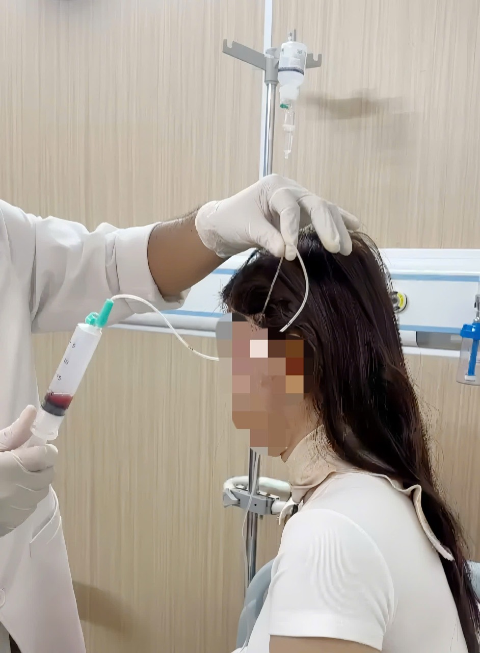 Tiêm filler không an toàn, một phụ nữ bị hoại tử mặt - Ảnh 1.