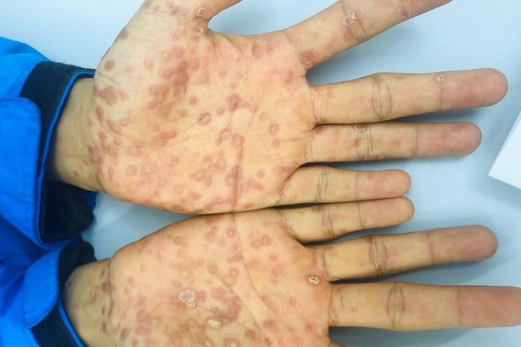 Bệnh nh&acirc;n dưới 18 tuổi kh&aacute;m da liễu, nghi ngờ bị x&acirc;m hại t&igrave;nh dục - Ảnh 1.