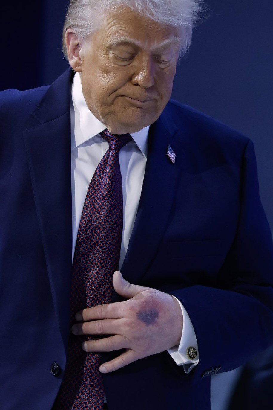 Nhà Trắng lý giải về vết bầm tím lạ trên tay Tổng thống Trump tại Davos - Ảnh 2.