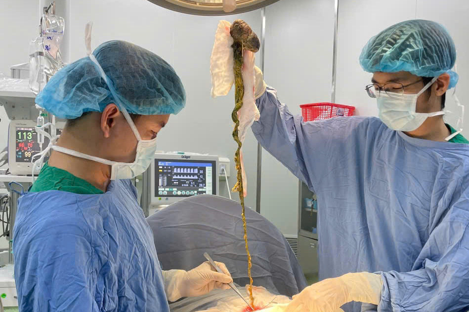 Bé trai 6 tuổi phải phẫu thuật vì ăn tóc - cảnh báo bệnh hiếm gặp - Ảnh 1.