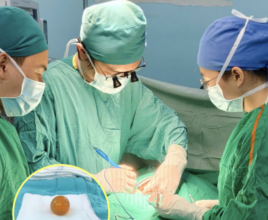 Bác sĩ cảnh báo nguy cơ Từ hạt đồ chơi gây tắc ruột ở trẻ em - Ảnh 1.