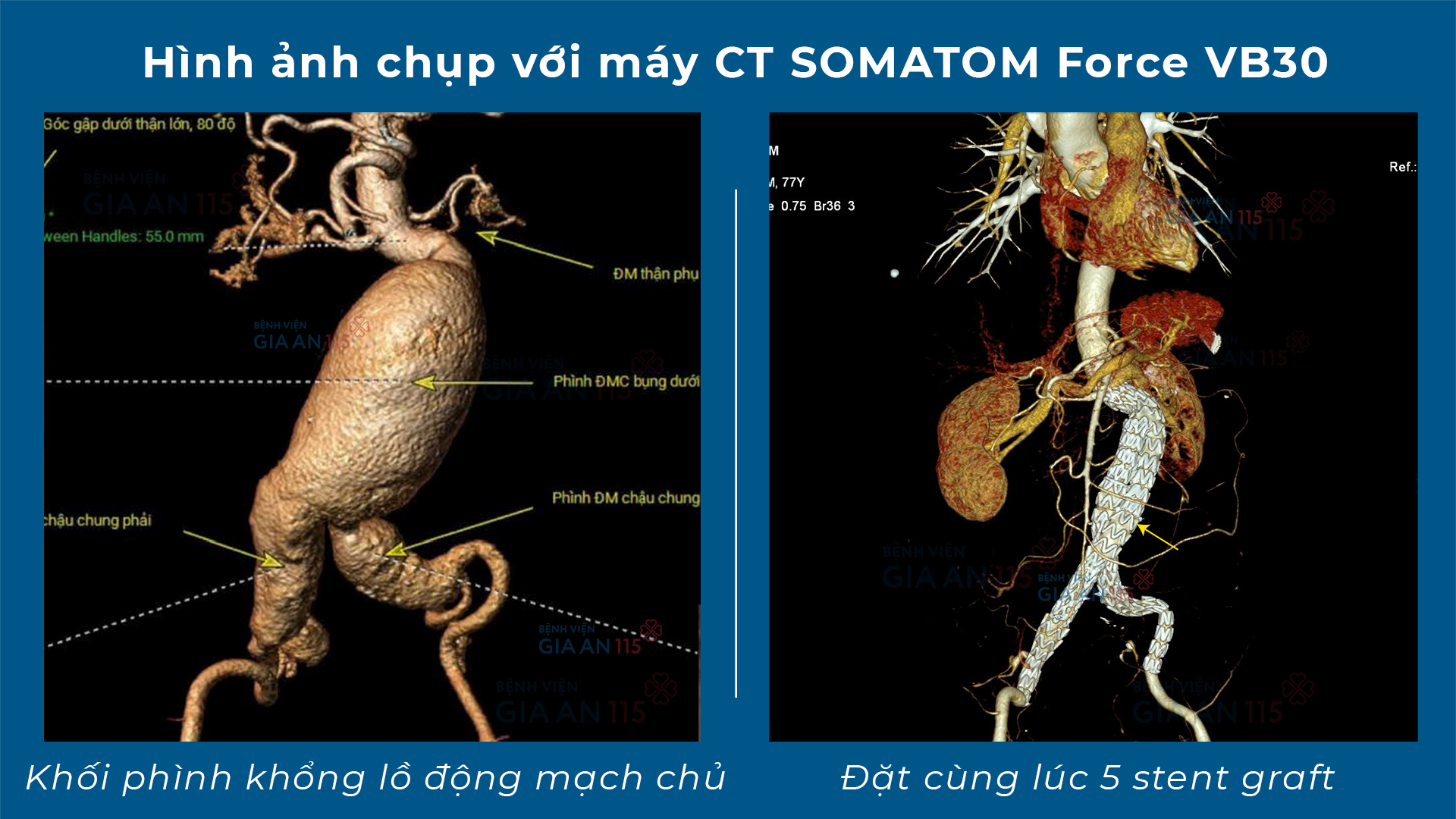 Đau bụng thông thường, vào viện đặt khẩn 5 stent cùng lúc - Ảnh 1.