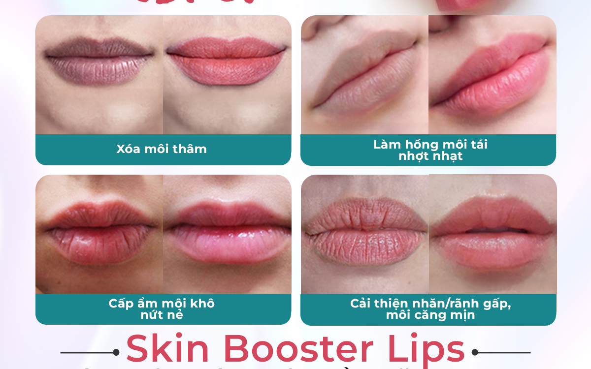 Top 3 nơi "trẻ hóa môi" uy tín tại TPHCM