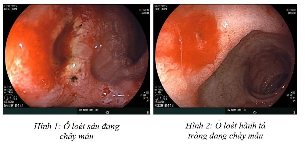 Xuất huyết dạ d&agrave;y v&igrave; stress, ăn uống thất thường ở người trẻ  - Ảnh 2.