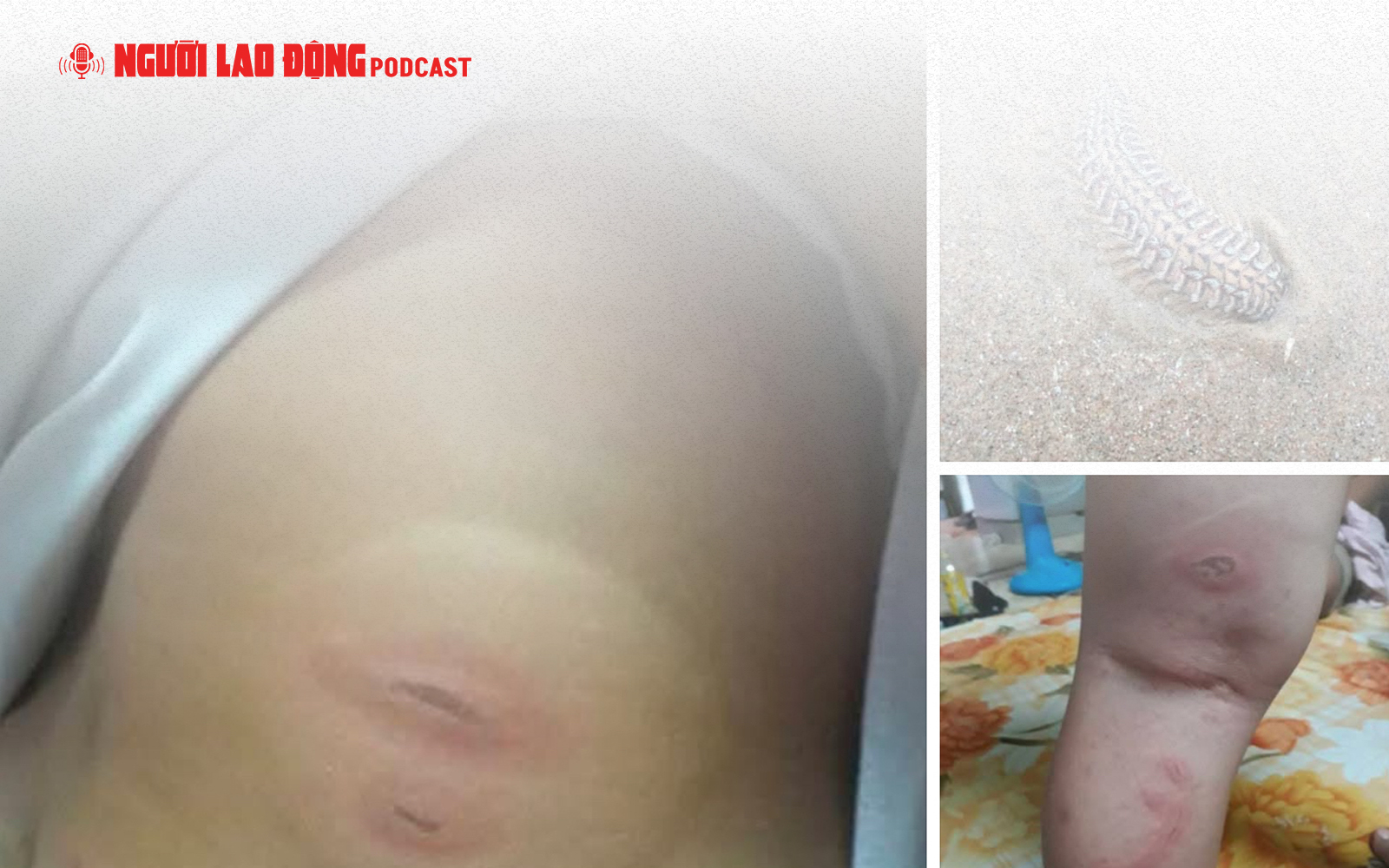 Sự thật vụ việc bé 3 tuổi "bị sâu biển cắn nguy kịch"