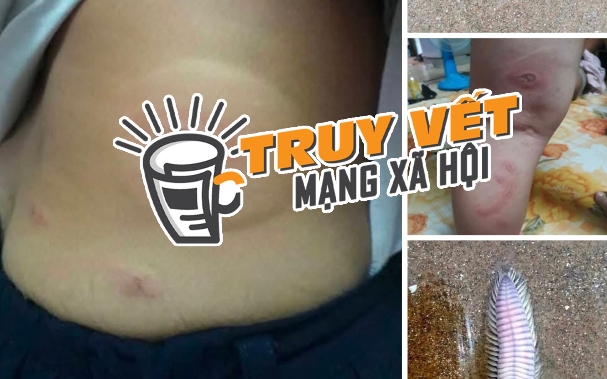 Thực hư thông tin bé 3 tuổi bị sâu biển cắn nguy kịch, gia đình tha thiết kêu gọi hỗ trợ máu hiếm
