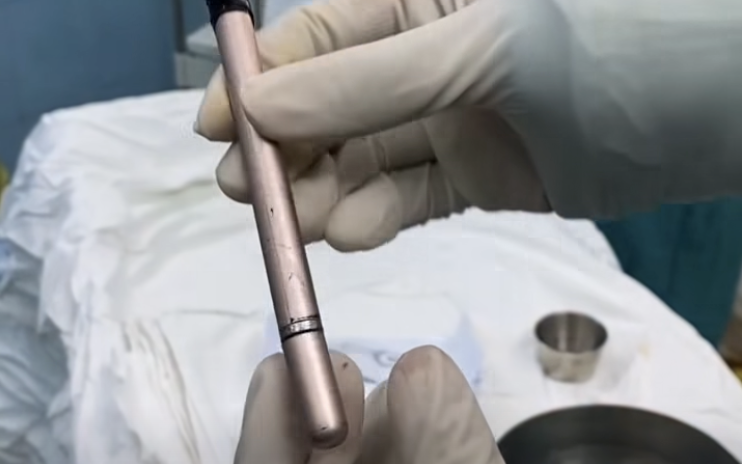 Thiếu nữ dùng cây bút gãi ngứa vùng kín rồi bị mắc kẹt trong bàng quang