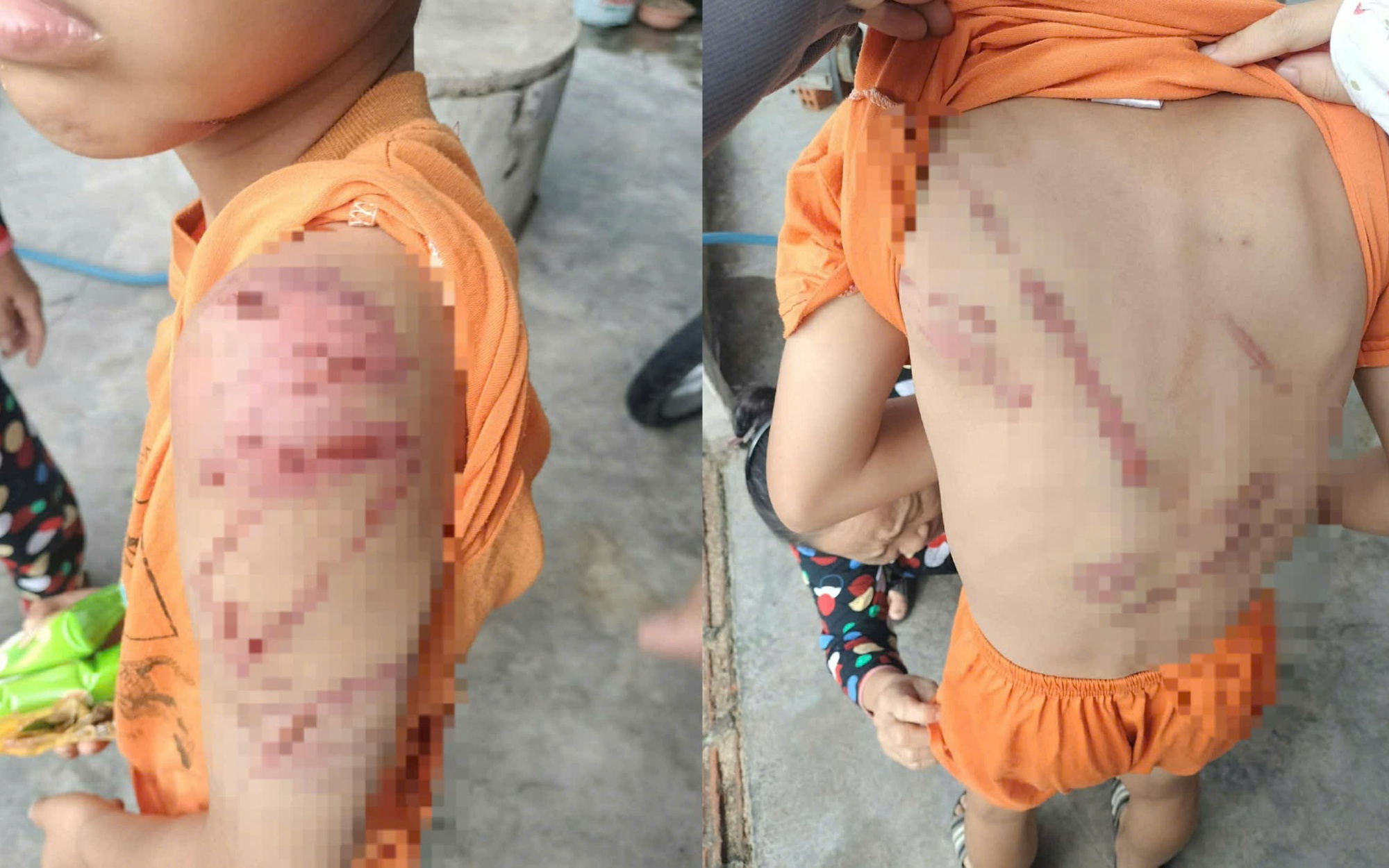 Xót xa hình ảnh cháu trai nghi bị cha đánh bầm tím khắp người
