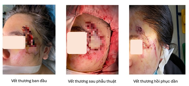 Cô gái hoại tử vùng mặt sau 3 ngày sau tai nạn giao thông - Ảnh 1.