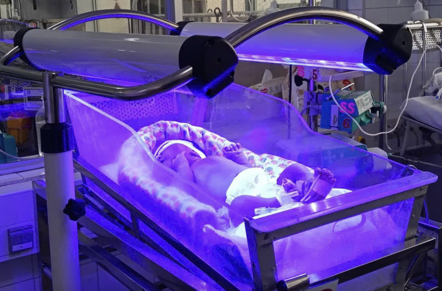 30 giờ sau sinh, bé sơ sinh phải thay máu vì vàng da sơ sinh nặng - Ảnh 1.