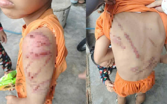 Lý do người cha đánh con 10 tuổi bầm tím khắp người