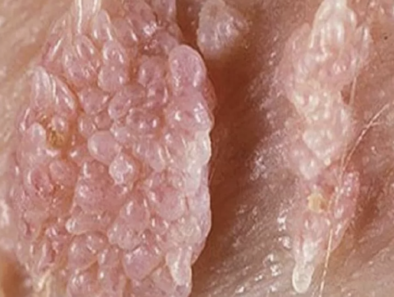 Người đàn ông gần 70 tuổi mắc sùi mào gà sau quan hệ không an toàn - Ảnh 1.