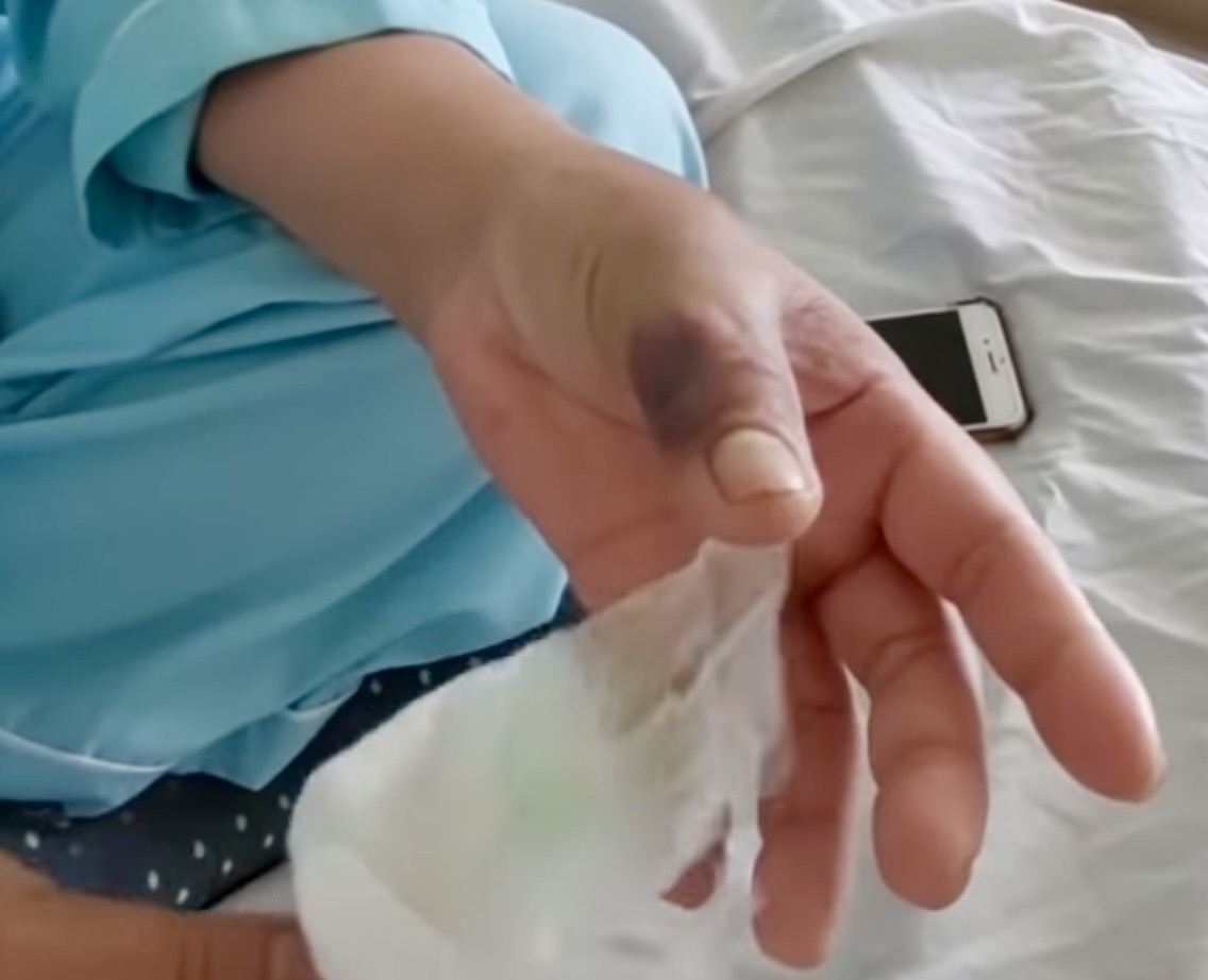 Bệnh viện b&aacute;o động số ca rắn cắn tăng mạnh m&ugrave;a h&aacute;i điều - Ảnh 1.