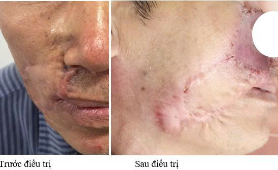 Ung thư da tái phát sau nhiều lần mổ, khối u âm thầm lan rộng - Ảnh 1.