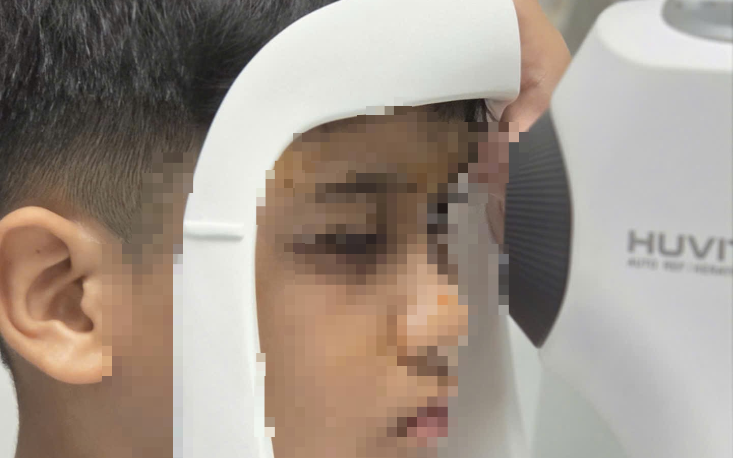 Một bé trai 10 tuổi bị đục thủy tinh thể 2 mắt