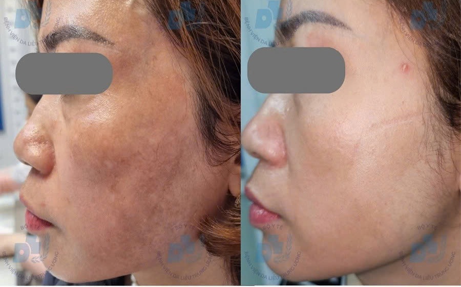 Nám da có nên điều trị bằng laser?