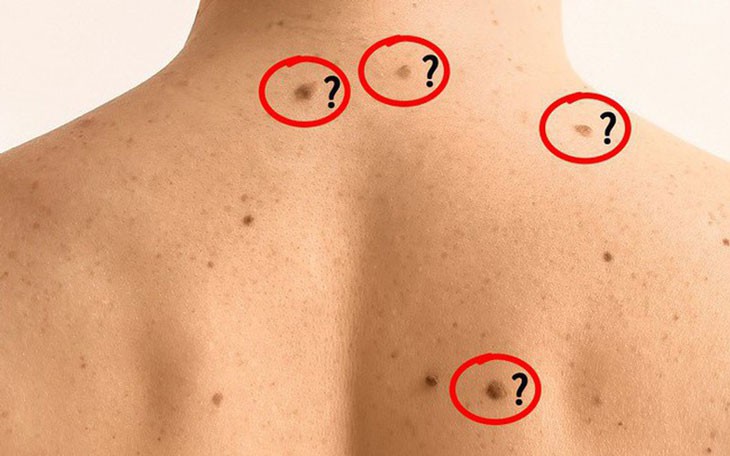 Nổi nhiều nốt ruồi là dấu hiệu ung thư?