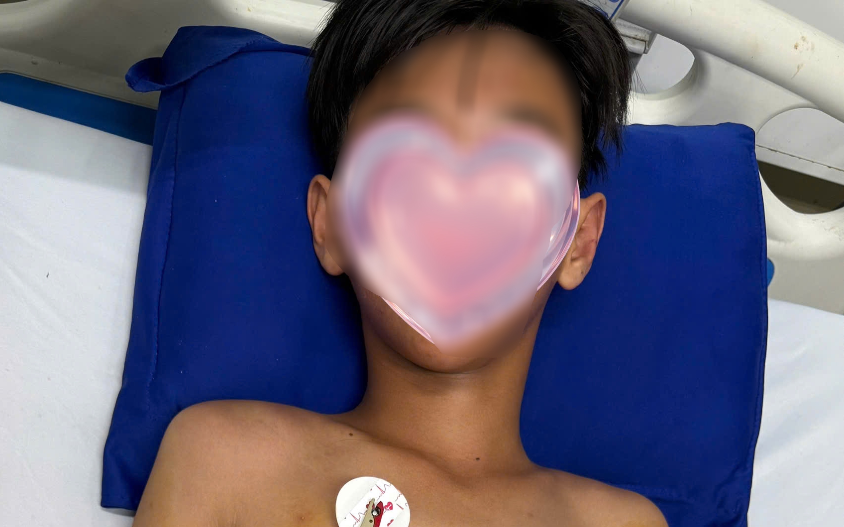Bé trai ở Cà Mau bị ong vò vẽ đốt hơn 50 vết
