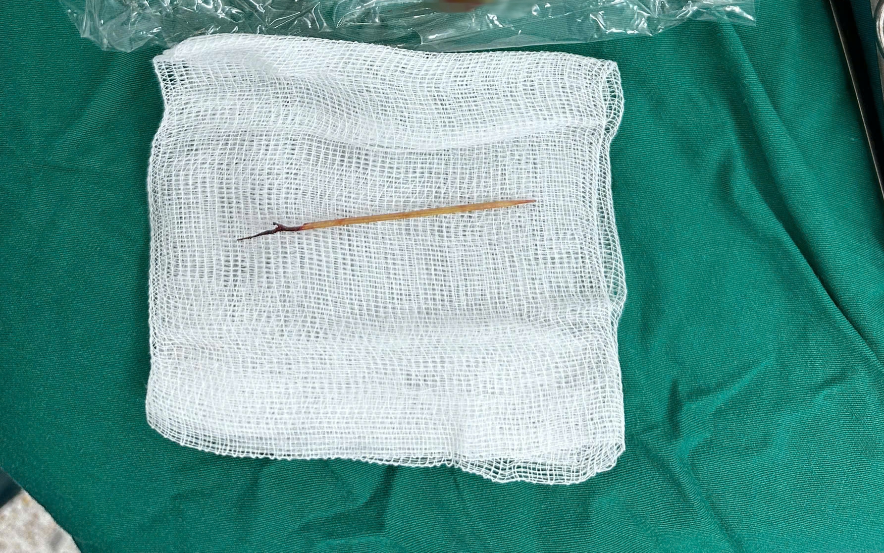 Bác sĩ sốc khi phát hiện chiếc tăm tre cắm trong tim bé trai 13 tuổi