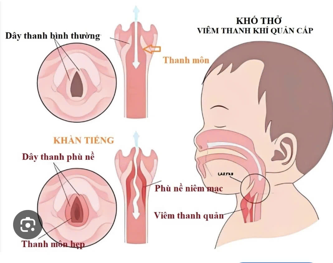 Sai lầm của cha mẹ l&agrave;m trẻ vi&ecirc;m thanh quản m&ugrave;a h&egrave; - Ảnh 2.