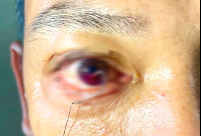 Lưỡi câu ghim vào mắt, người đàn ông phải cấp cứu khẩn cấp - Ảnh 1.