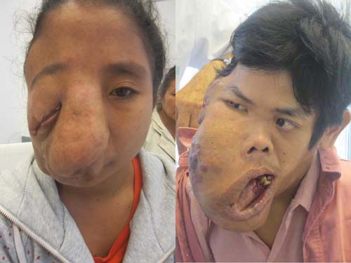 Hai bệnh nhân có gương mặt quá biến dạng