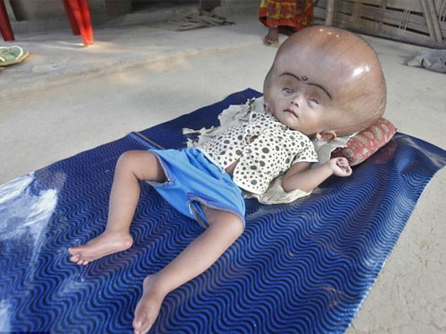 Đau lòng cô bé não úng thủy