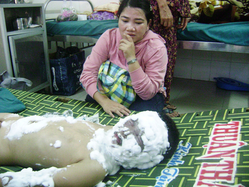 Nổ tủ điện, một bé phỏng nặng